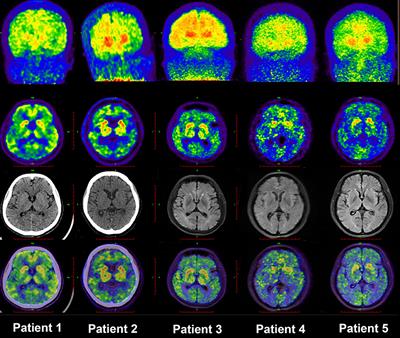 Prominent Striatum Amyloid Retention in Early-Onset Familial Alzheimer's Disease With PSEN1 Mutations: A Pilot PET/MR Study